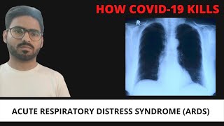 How Corona Virus Spread And Kills : Acute Respiratory Distress syndrome(ARDS)