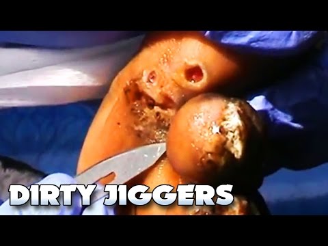 Big Black Jiggers!  Foot Blackheads