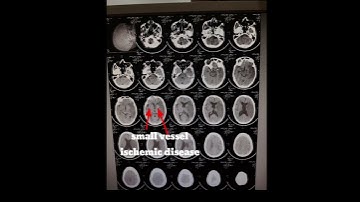 Abnormal brain #ct scan findings #radiology #shortvideo