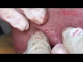 Acne treatment in Ha Quyen Spa on 11/06/2019 Part 2 - Điều trị mụn tại Hà Quyên Spa