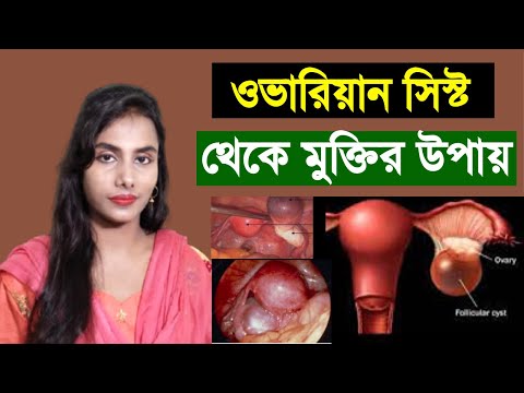 ভিডিও: ডিম্বাশয় সিস্টের চিকিৎসার টি উপায়