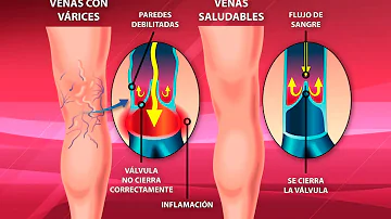 ¿Por qué se salen las venas?