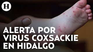 Alerta en Hidalgo por brote del virus coxsackie, un virus similar al polio y la hepatitis