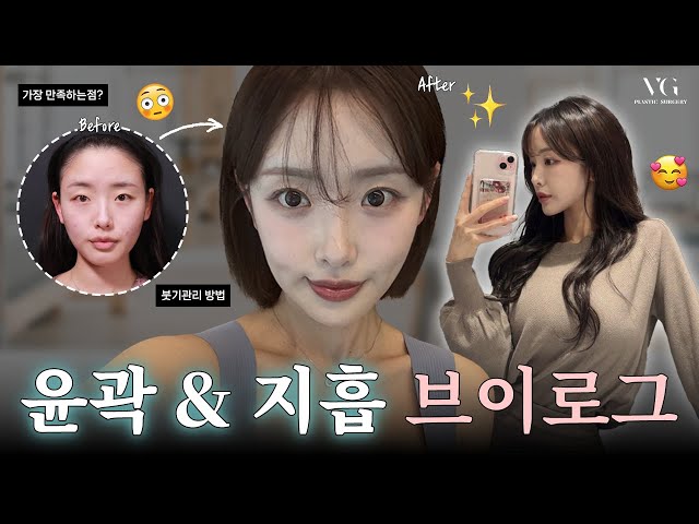 윤곽 3종&지방 흡입 솔직후기 성형VLOG✨ I 성형후기 I VLOG I 안면윤곽 I 복부지흡 I