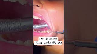تنظيف الأسنان | إزالة تقويم الاسنان viral trending dr_eslam_nabil