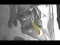 Huge L5 Disc Extrusion Enters Anterior Sacral Foramen! Regional Anatomy & Detailed Case Analysis.