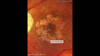 AGE-RELATED MACULAR DEGENERATION MULTIMODAL ANALYSIS For more images like this visit www.retinograph