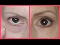 GET RID OF TEAR TROUGHS (UNDER EYE BAGS) & DARK CIRCLES!