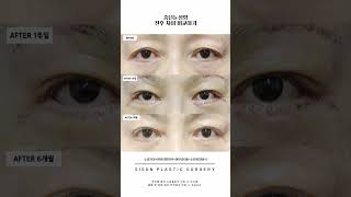 ★중년눈성형★ 전후 차이 비교하기 #shorts #시선성형외과