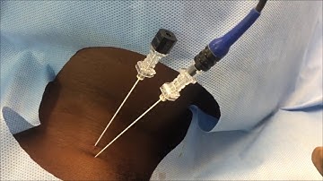 Cervical 3rd occipital nerve and medial branch radiofrequency ablation