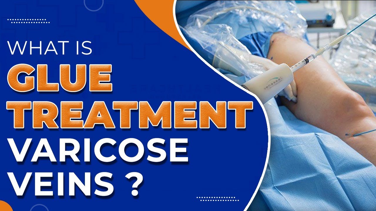 What is glue treatment for varicose vein? drmohalbanker 