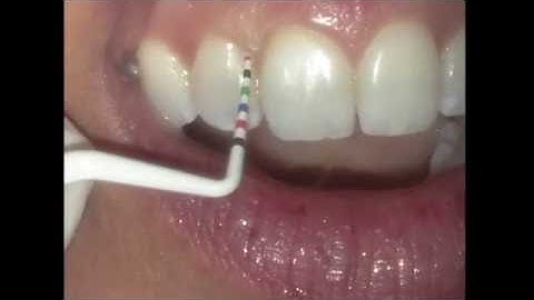 Colorvue® Goldstein Probe By Hu-Friedy