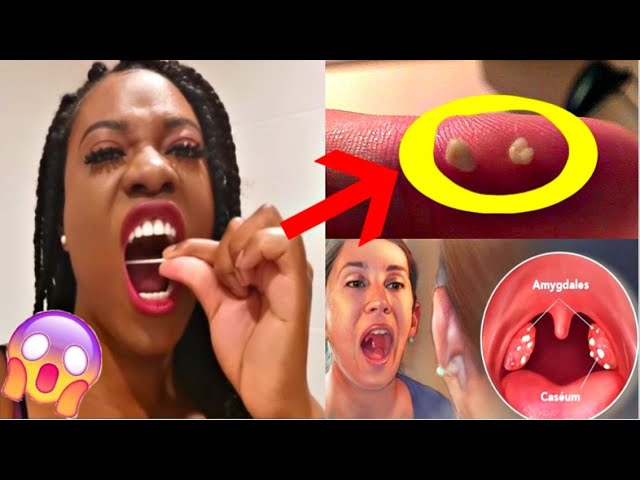 😱COMMENT ENLEVER LES BOULES BLANCHES DANS LA BOUCHE (CASEUM) 😱 