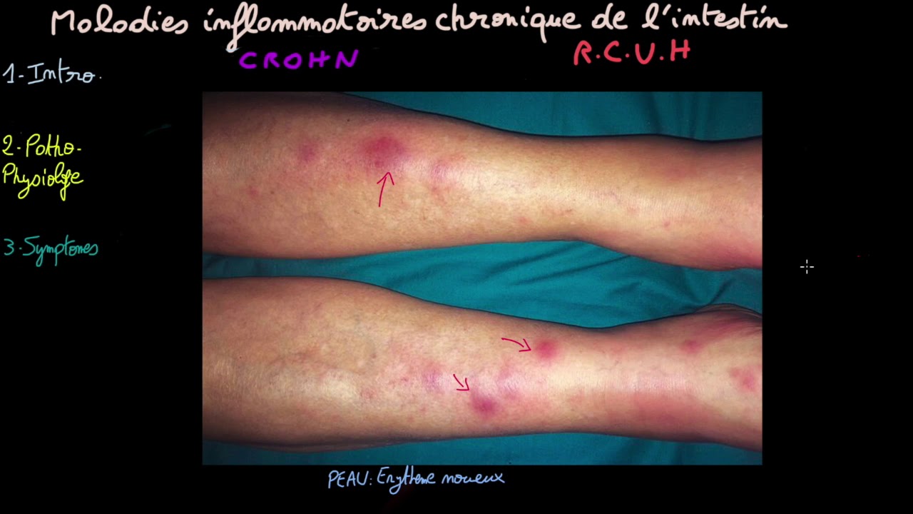 Crohn - Recto-colite-ulcéro-hémorragique - Docteur Synapse