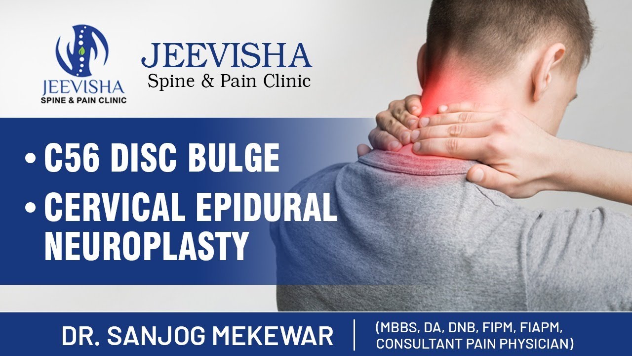 Neck pain One Minute Video of Cervical Epidural Neuroplasty YouTube