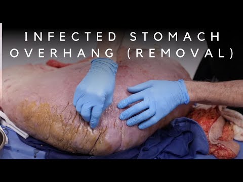 TRANSFORMATION JOURNEY - Removing 70lbs with a Panniculectomy Procedure with Dr. Katzen