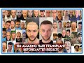 150 amazing hair transplant beforeafter results