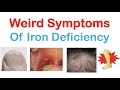 Weird Symptoms of Iron Deficiency | Nails, Tongue, Skin, Hair &amp; Others