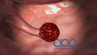 Gastrointestinal Polyps -  3D Medical Animation || ABP ©