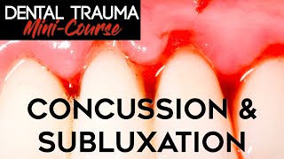 Dental Trauma Mini-Course - Part 7 - Dental Trauma Guide - Concussion &amp; Subluxation Injuries