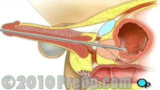 Cystoscopy Surgery - Male Penis PreOp® Patient Education Feature