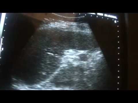 ultrasound study ENLARGED LYMPH NODES at SPLENIC hilar region - YouTube