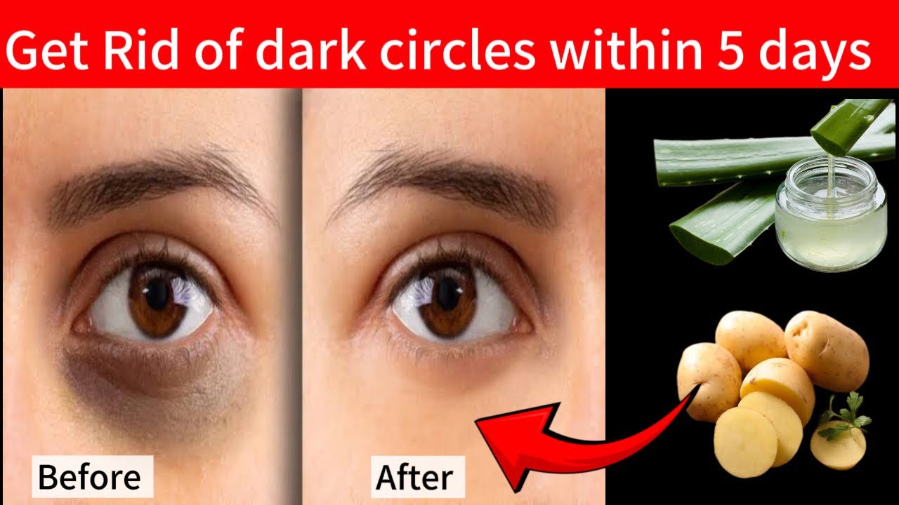 Simple home remedies for dark circles/ remove dark circles within 5 ...