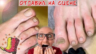 Педикюр звезде / Онихолизис - отдавил палец на сцене