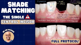 How to Shade Match the Single Central Incisor  PDP165