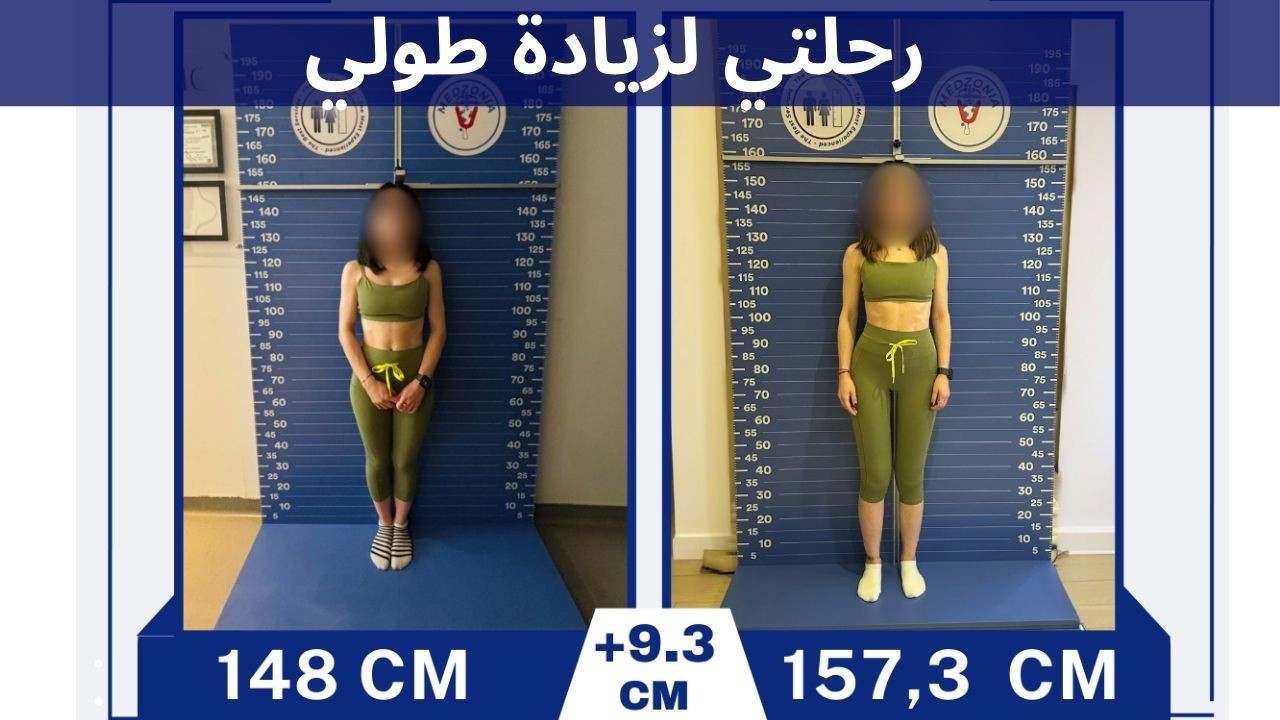 بعد عملية إطالة القامة: بداية جديدة بثقة (9.3 سم)