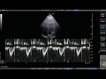 Pulse Wave Doppler Step By Step LVOT VTI Example Pulse Wave Doppler Step By Step LVOT VTI Example