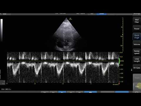 Pulse Wave Doppler Step by Step - LVOT VTI Example