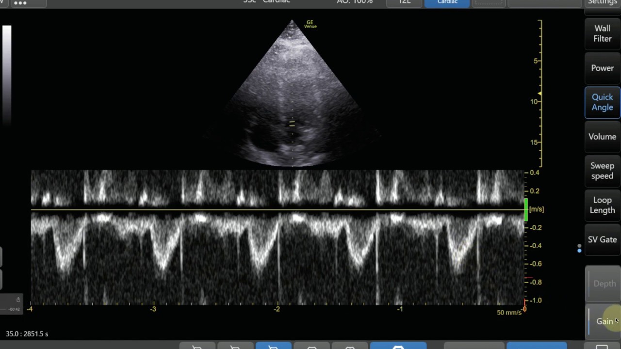 lvot vti とは