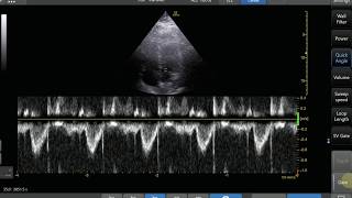 Pulse Wave Doppler Step by Step - LVOT VTI Example screenshot 3