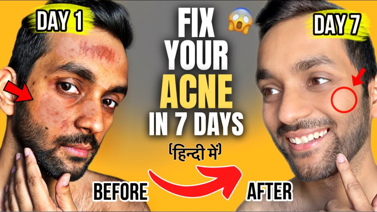 10 HABITS TO CURE SEVERE ACNE MY WORST ACNE JOURNEY Acne Treatment 10-habits-to-cure-severe-acne-my-worst-acne-journey-acne-treatment