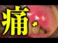 患者「痛 痛っ 痛たたたっ」 気になってしょうがない口内炎を歯医者かおりがレーザービームでしばきます