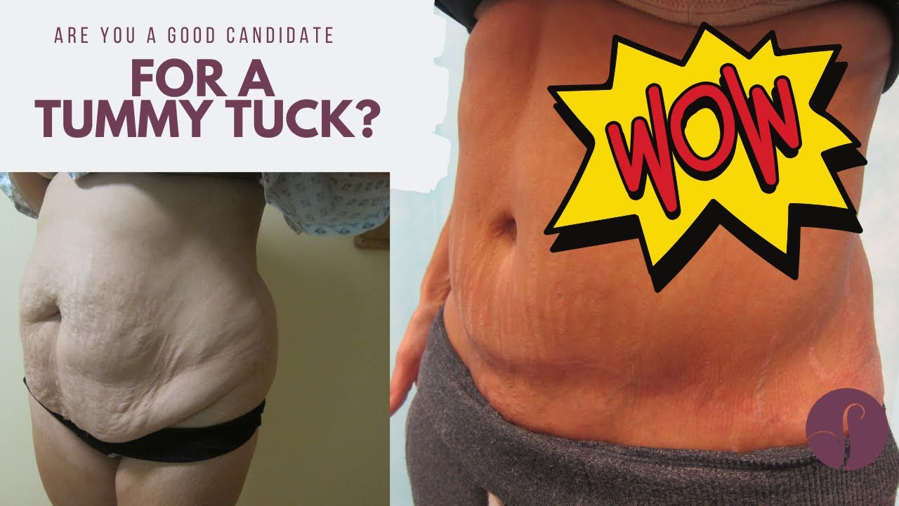 Are you a good candidate for a tummy tuck? 