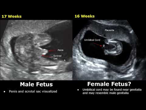 Fetal Gender Determination On Ultrasound | Determining The Sex Of A Baby On USG (Boy/Girl)