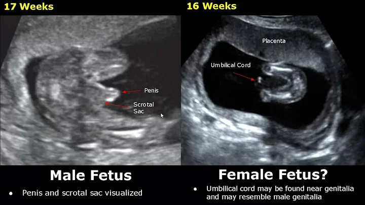 Fetal Gender Determination On Ultrasound | Determining The Sex Of A Baby On USG (Boy/Girl) - DayDayNews