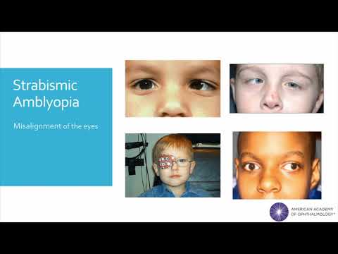 ቪዲዮ: Amblyopia anopsia ምንድን ነው?