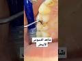 كيفية إزالة تسوس الأسنان التسوس الأبيض للاشتراك تابعني Dental Clinic دكتور اسنان 