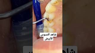 كيفية إزالة تسوس الأسنان || التسوس الأبيض #للاشتراك  #تابعني #dental_clinic #دكتور_اسنان