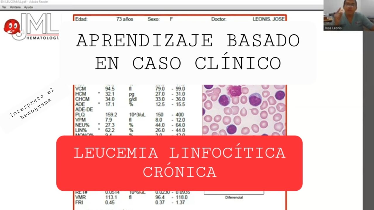 LEUCEMIA LINFOCÍTICA CRÓNICA. APRENDIZAJE BASADO EN CASO CLÍNICO. #