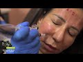 PRP with MICRONEEDLING for the face - Part 2 | Bodyrx Louisville