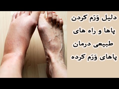 تصویری: 3 روش ساده برای مقابله با ادم در پاها