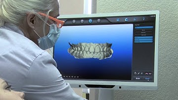 iTero Scan for Invisalign Treatment