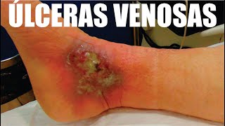 TODO sobre la ÚLCERA VENOSA (VARICOSA) 🦶 VÁRICES y Complicaciones 🦵 Dr  IVÁN GUTIÉRREZ / FLEBOCENTER - YouTube