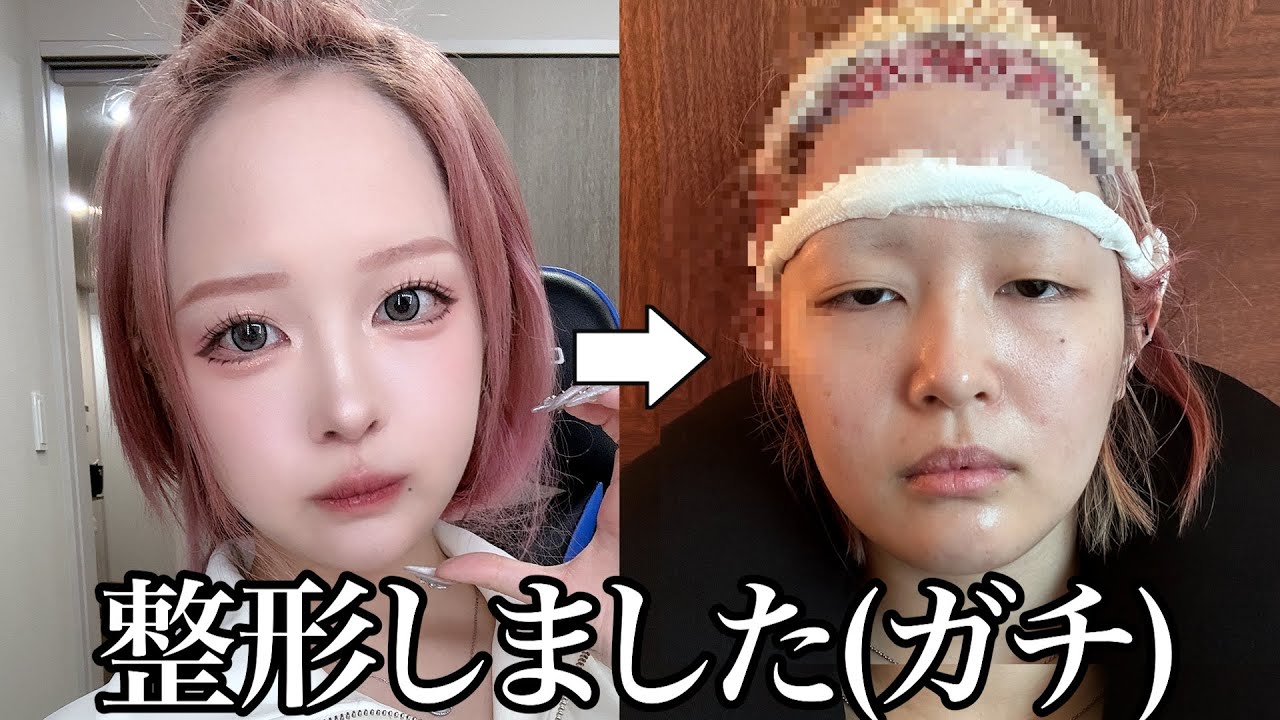 コメントでもいじられてきたデコハゲを整形で狭くしました