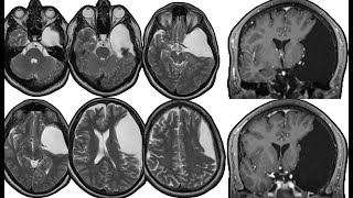 Arachnoid Cyst. Microscopic Approach. Basal Cistern Fenestration.