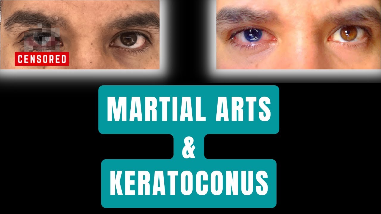 My life with Keratoconus - I Lost My Eye - I have prosthetics in both eyes now